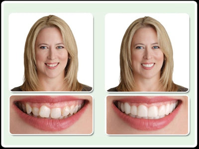 instant smile dentures